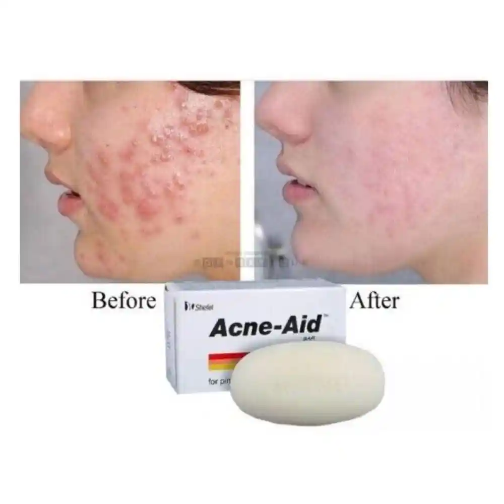 Acne Aid Soap Bar