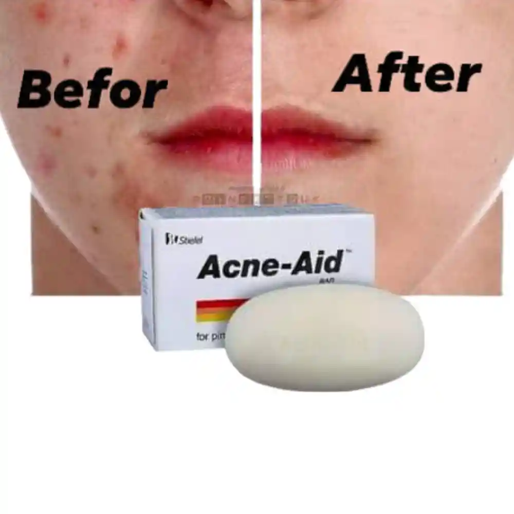 acne aid bar soap review