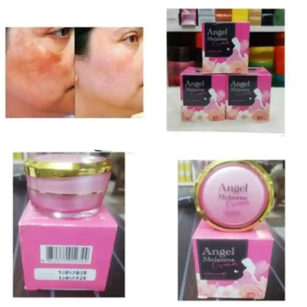 best cream for melasma in indiau200b
